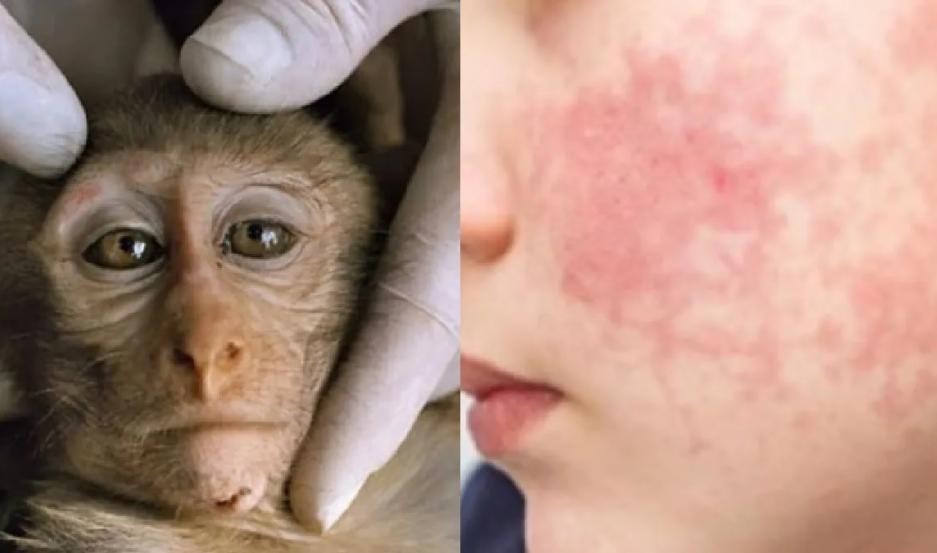 La viruela del mono: cuáles son los síntomas y cómo se transmite